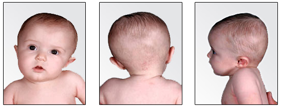 plagiocephaly adult with